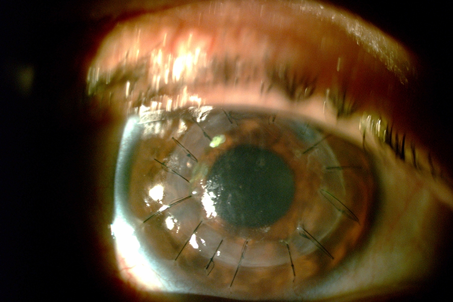 cirugia de queratoplastia o trasplante de cornea