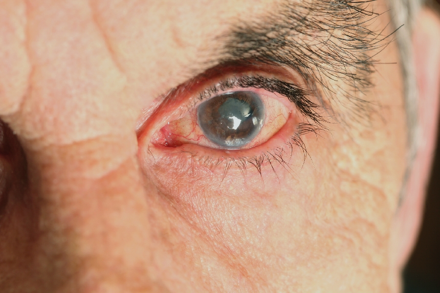 1 que es el glaucoma