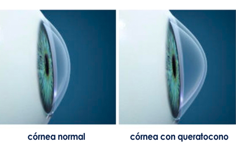 1 que es el queratocono
