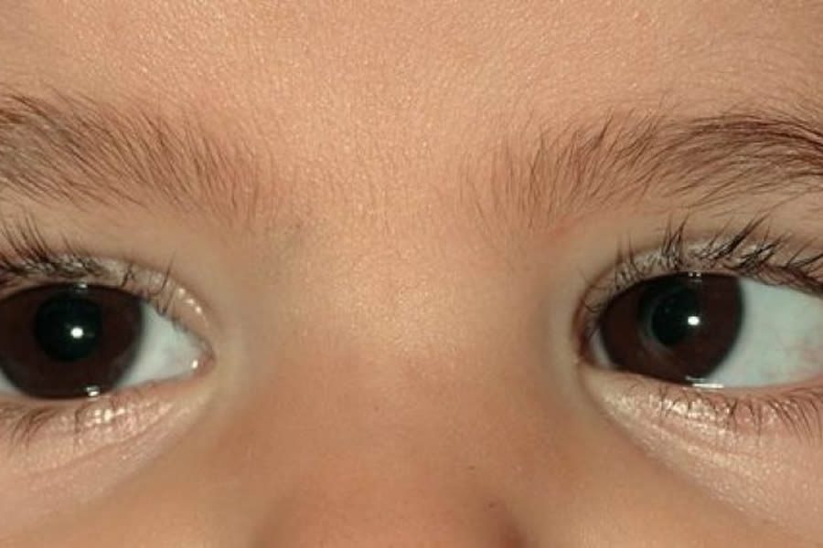 2 cuales son los tipos de estrabismo