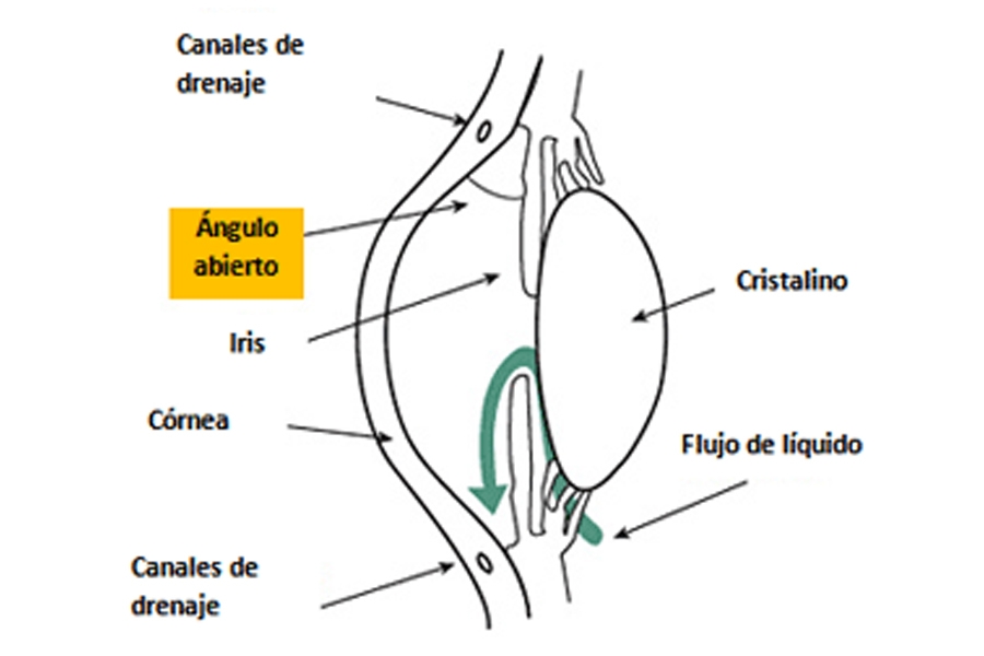 511 glaucoma de Angulo abierto