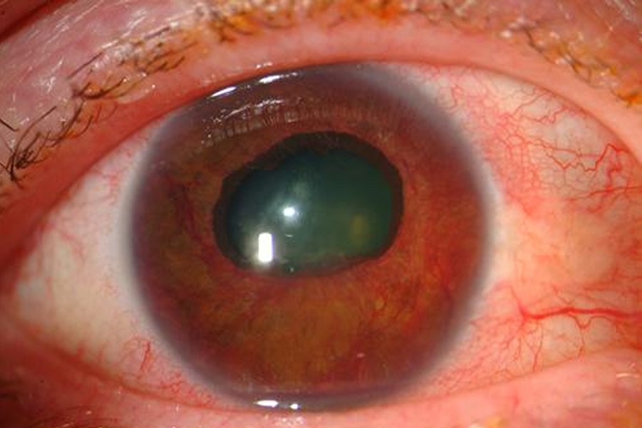 5221 glaucoma neovascular