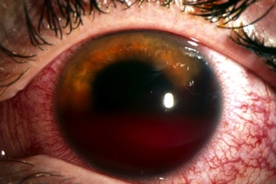 5223 glaucoma traumatico