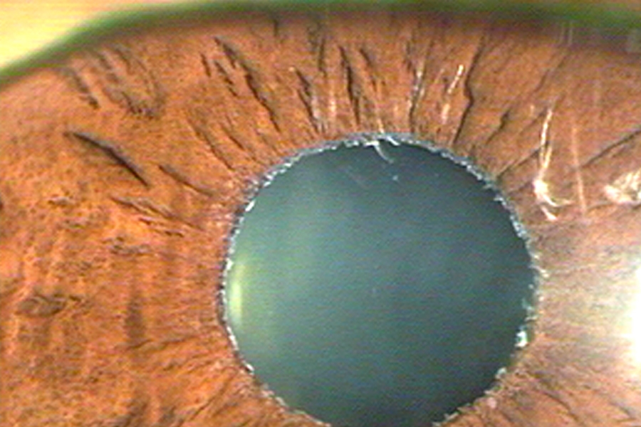 5225 glaucoma pseudoexfoliativo