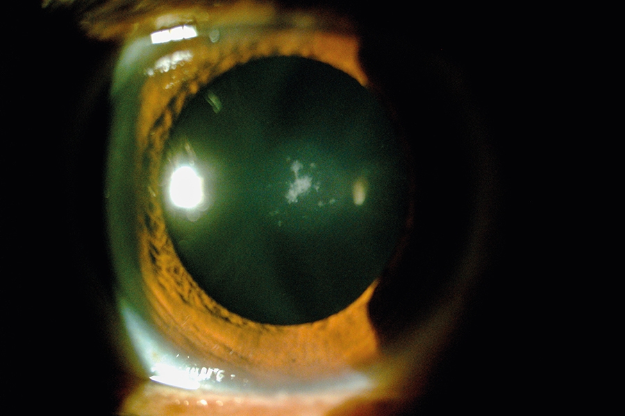53 catarata subcapsular posterior