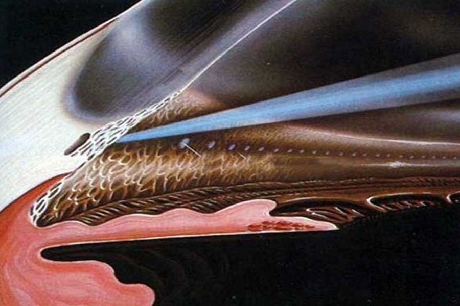 922 trabeculoplastia con laser de argon tla