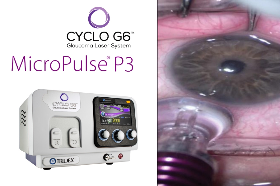 924 ciclofotocoagulacion transescleral con laser iridex
