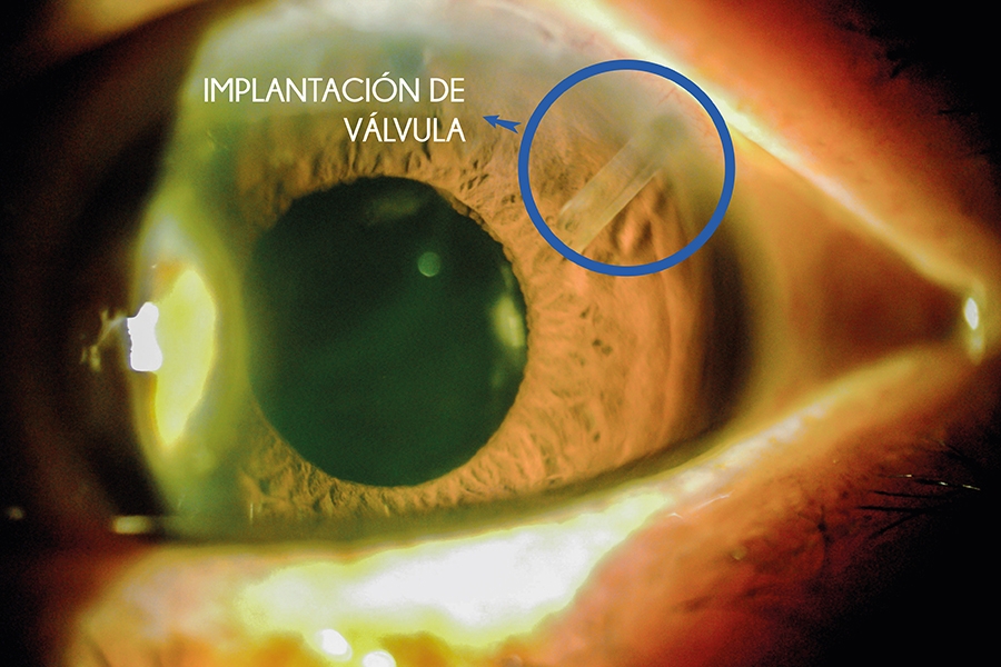 926 implantacion de dispositivo de drenaje valvula