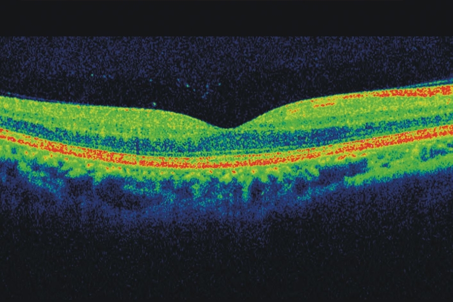 que patologias oculares podemos diagnosticar mediante un examen de tomografia de coherencia Optica