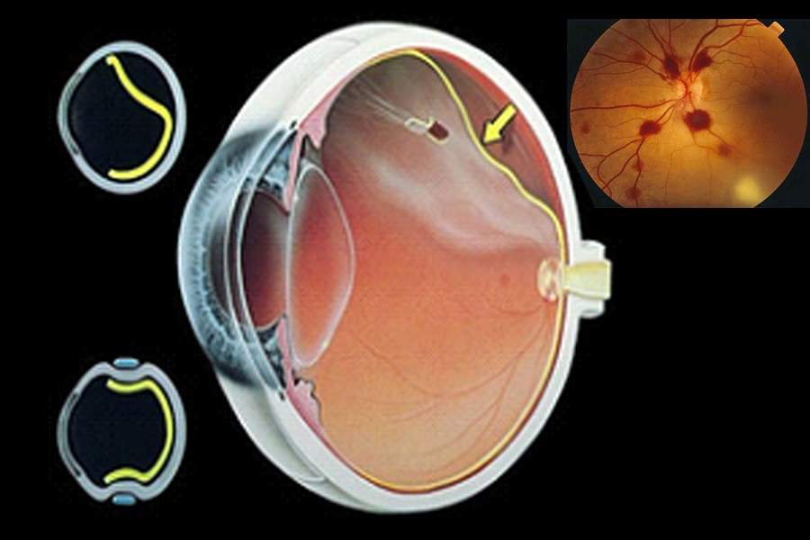 en que pacientes esta indicado la fotocoagulacion de retina laser argon